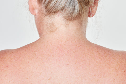 The best treatments for keratosis pilaris in 2024